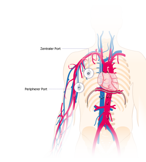 Portkatheter Und Portkan Len Vygon