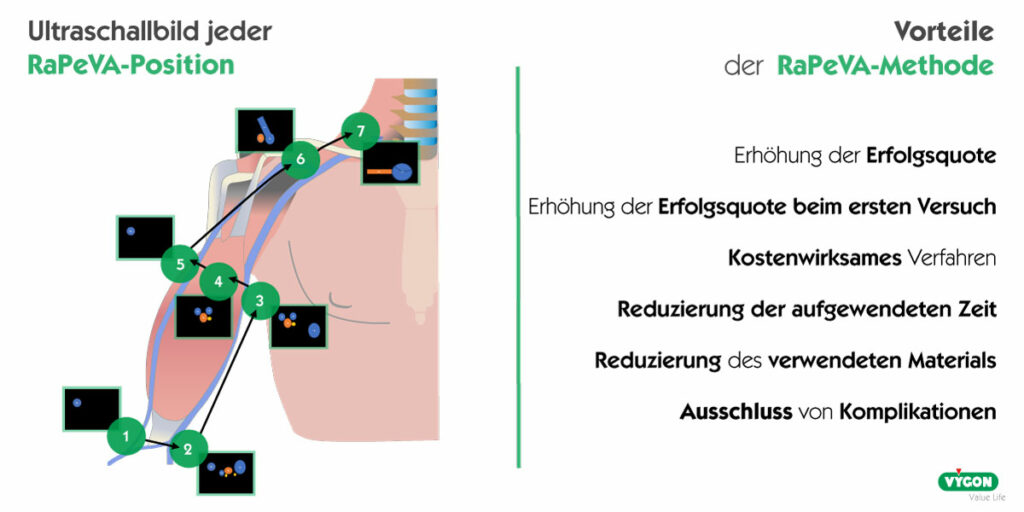 Vorteile-der-RaPeVA-Methode